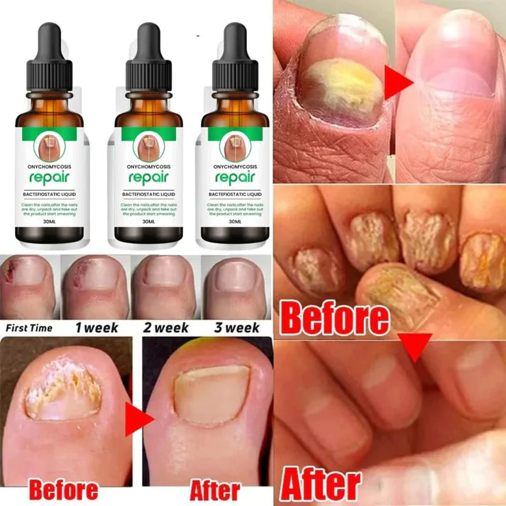 D-More All In One Nail Serum š„Doctors 1st Choice š„(Top Rated)