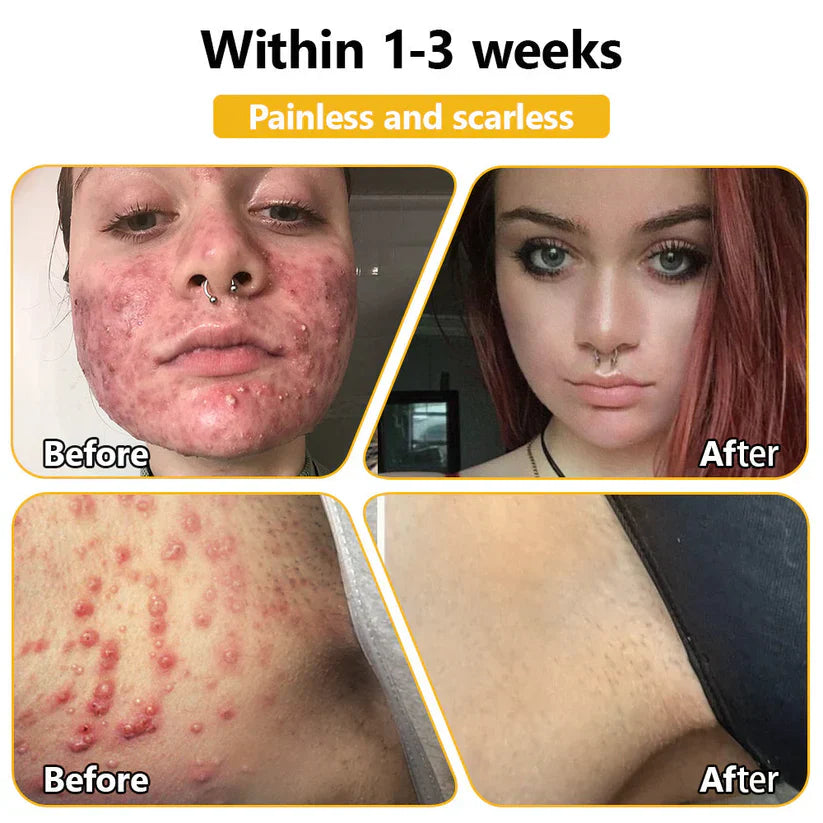 BEE VENOM SKIN TREATMENT CREAM (BUY 1 GET 1 FREE)