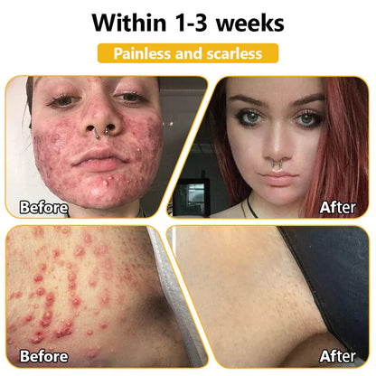 BEE VENOM SKIN TREATMENT CREAM (BUY 1 GET 1 FREE)