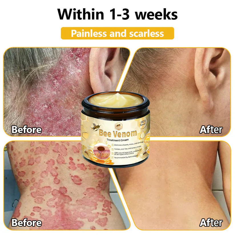 BEE VENOM SKIN TREATMENT CREAM (BUY 1 GET 1 FREE)