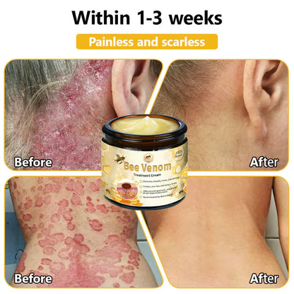 BEE VENOM SKIN TREATMENT CREAM (BUY 1 GET 1 FREE)