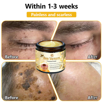 BEE VENOM SKIN TREATMENT CREAM (BUY 1 GET 1 FREE)