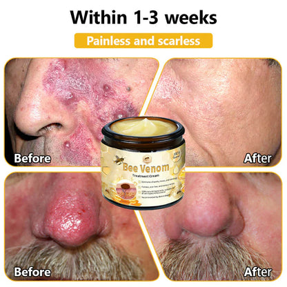 BEE VENOM SKIN TREATMENT CREAM (BUY 1 GET 1 FREE)
