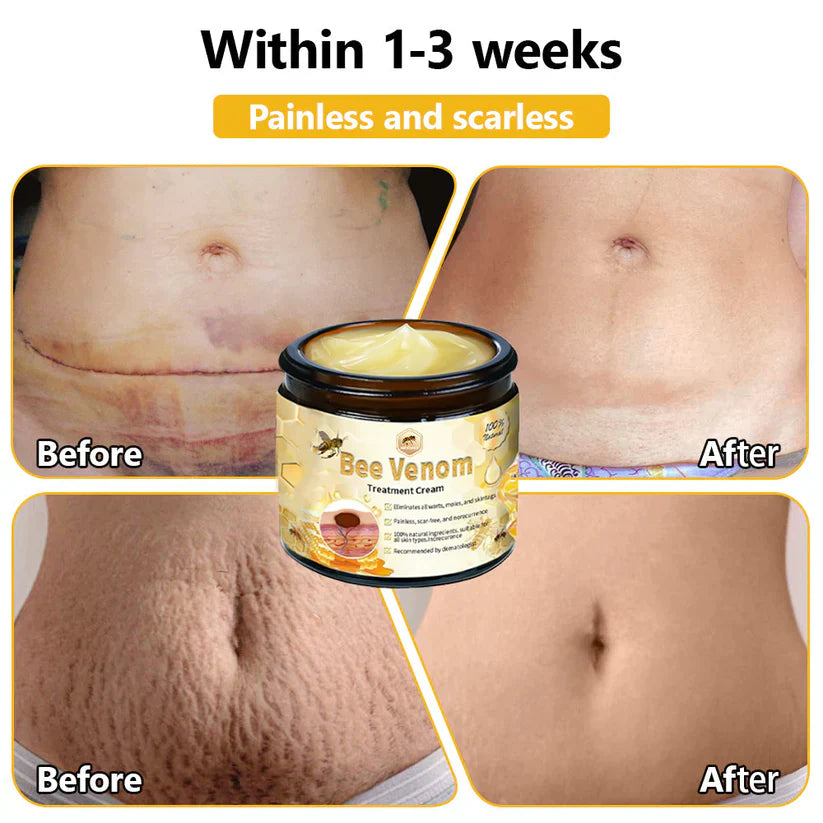 BEE VENOM SKIN TREATMENT CREAM (BUY 1 GET 1 FREE)