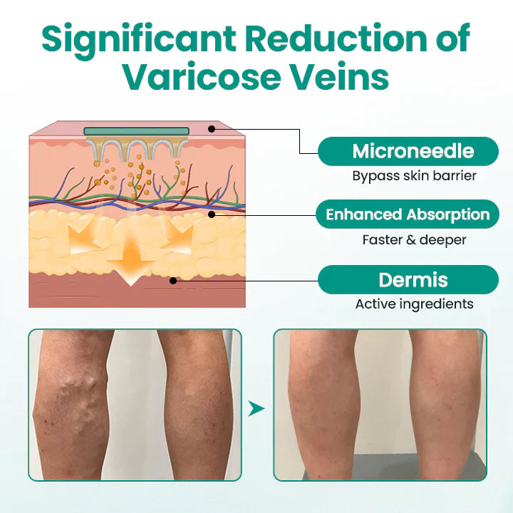Magnetic Therapy Varicose Veins Patch (PACK OF 100)