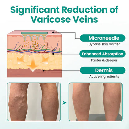 Magnetic Therapy Varicose Veins Patch (PACK OF 100)