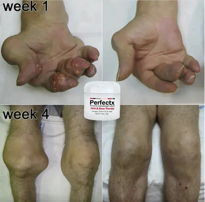 Perfectx Joint and Bone Treatment Cream (Buy 1 Get 2 Free)