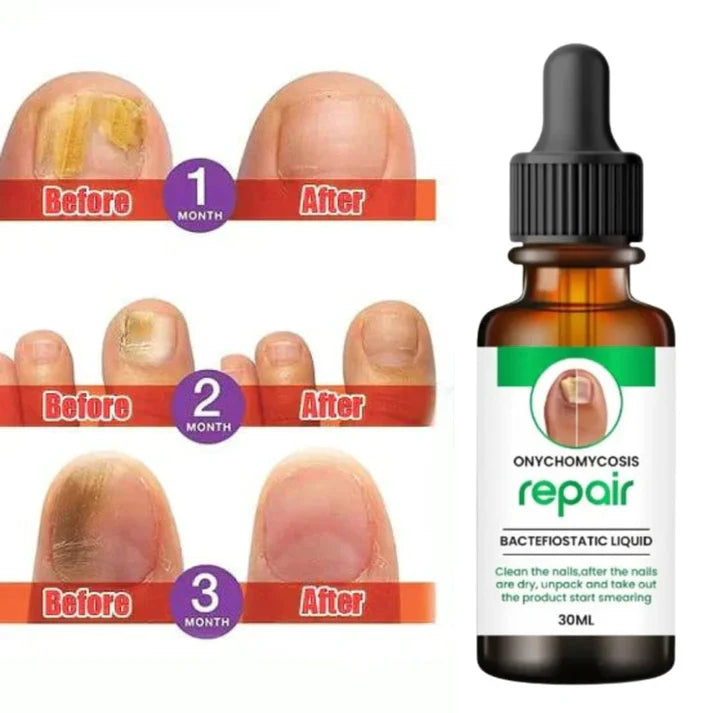 D-More All In One Nail Serum 🔥Doctors 1st Choice 🔥(Top Rated)